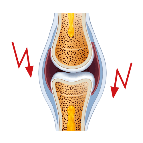 flexadin-osteoarthrose-grafik-1 Entzündung des Gelenks durch Reize