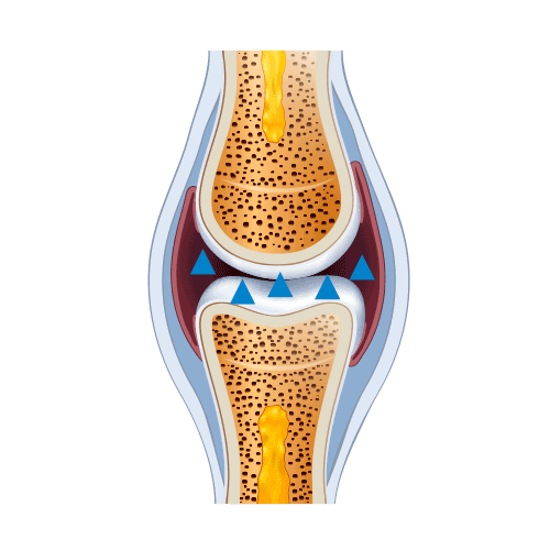 flexadin-osteoarthrose-grafik-2 Kollagenstückchen werden aus Gelenkknorpel frei