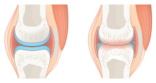 flexadin-entstehung-arthrose Gesundes Gelenk gegenübergestellt mit Gelenk in dem Knochen auf Knochen reibt